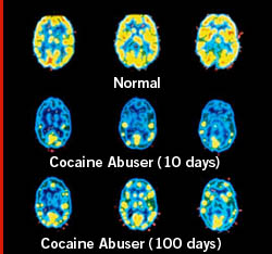 cocaine-brain